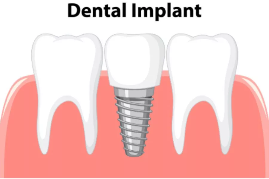 Dental Implant