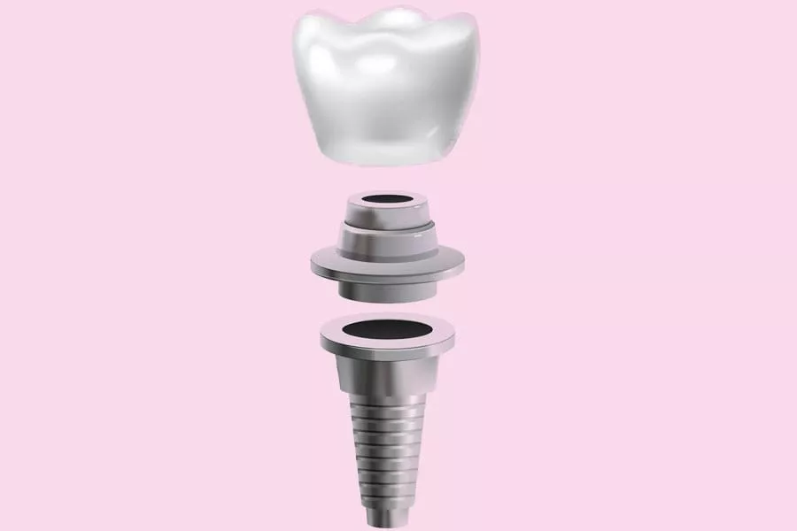 Dental Implants in Pensacola