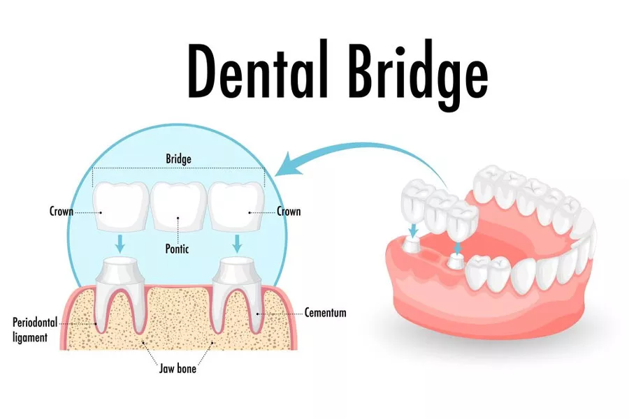 Dental Bridge