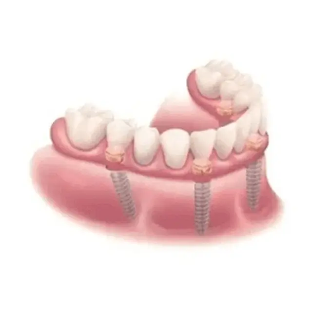 Permanent Teeth All-on-X