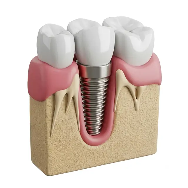 Single Tooth Implant