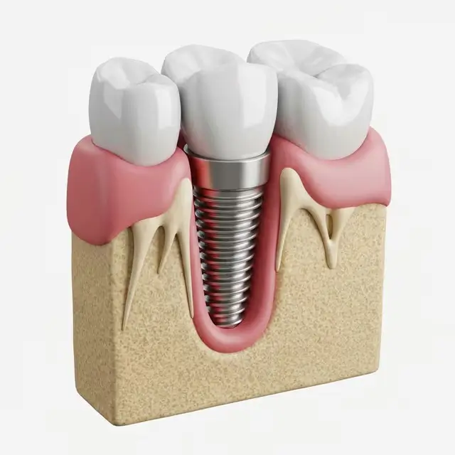 Single Tooth Implant