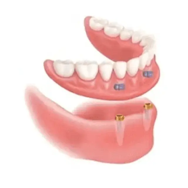 Snap-On Dentures